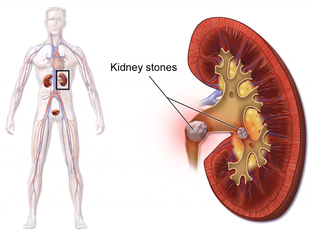 Blausen_0595_KidneyStones-compressor