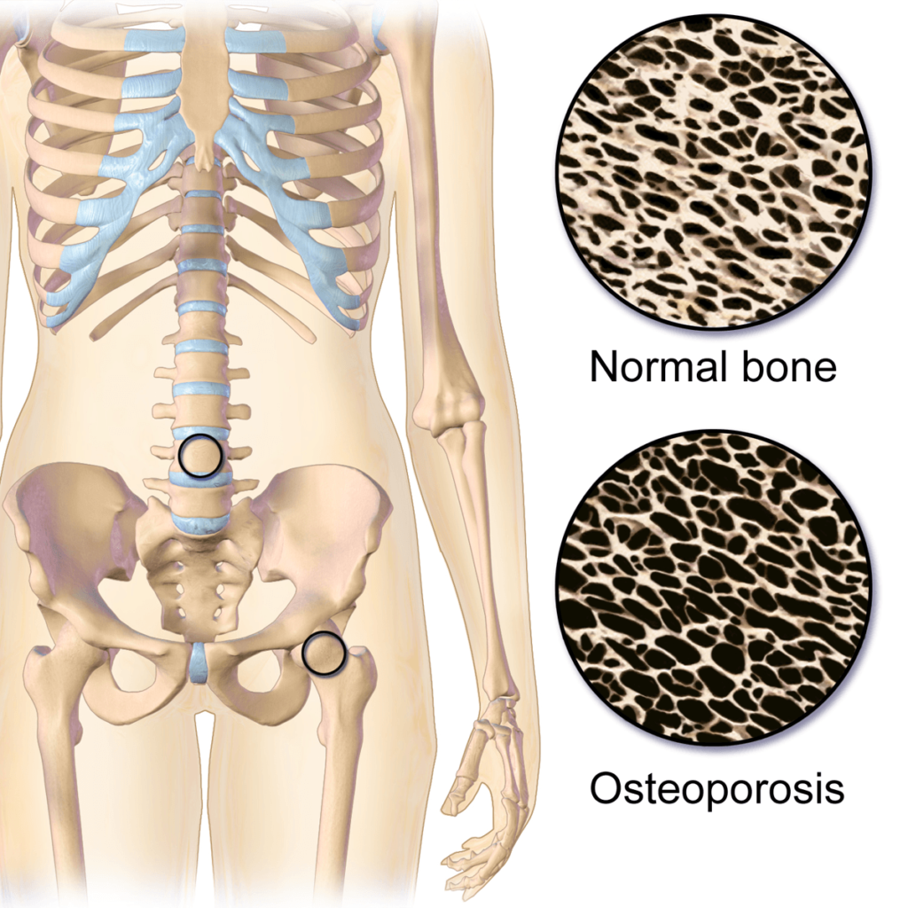 Osteoporosis Locations Compressor 1024x1024