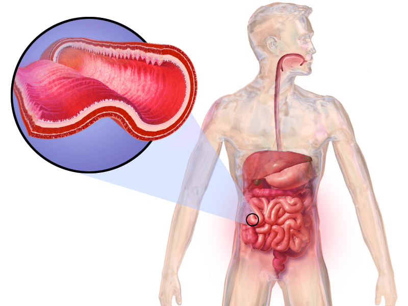 Crohns Disease Min