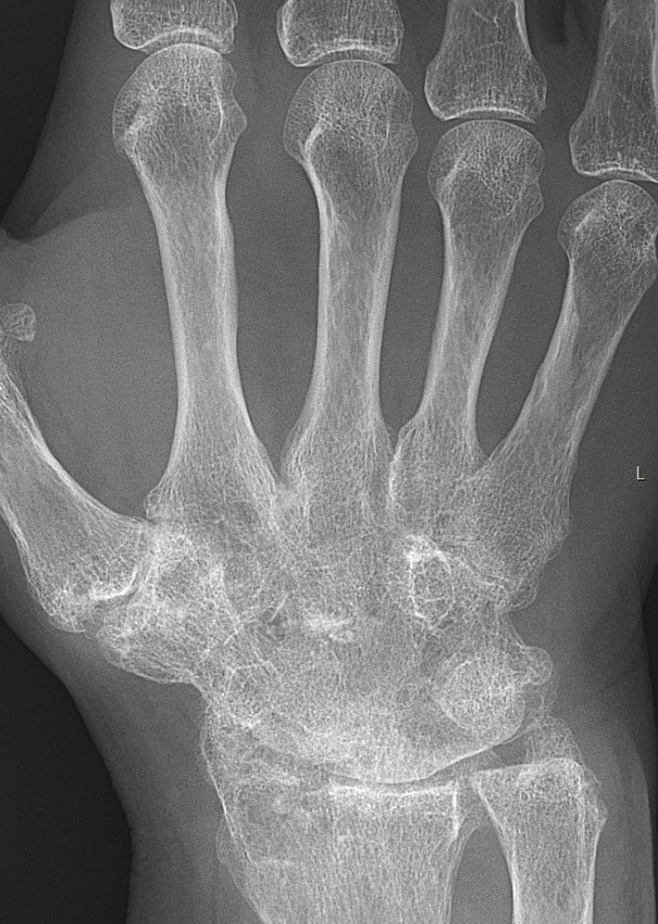 Rheumatoid Arthritis With Carpal Ankylosis 2017 Min