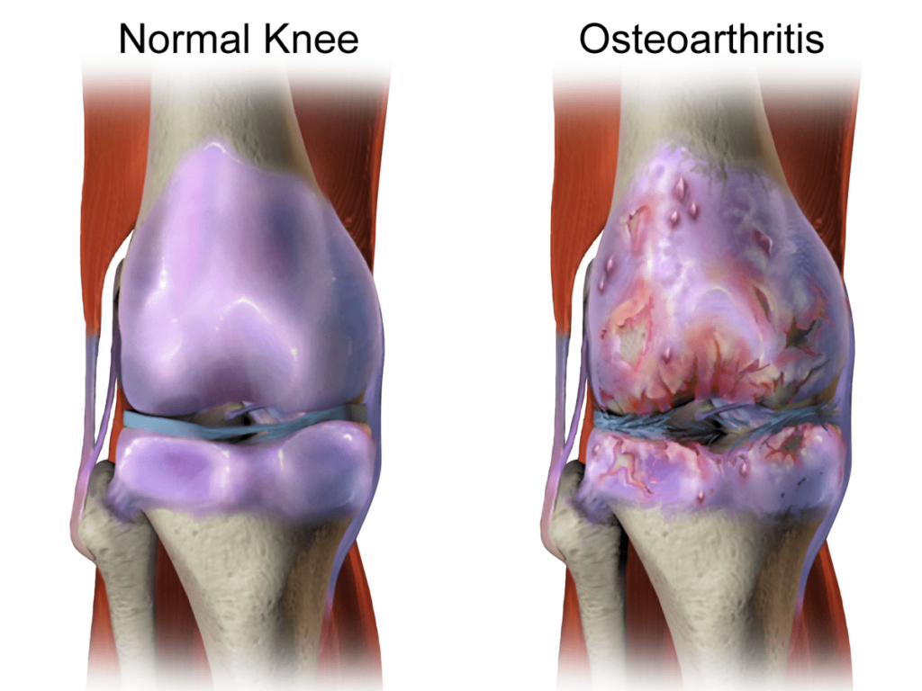 Osteoarthritis Min 1024x768