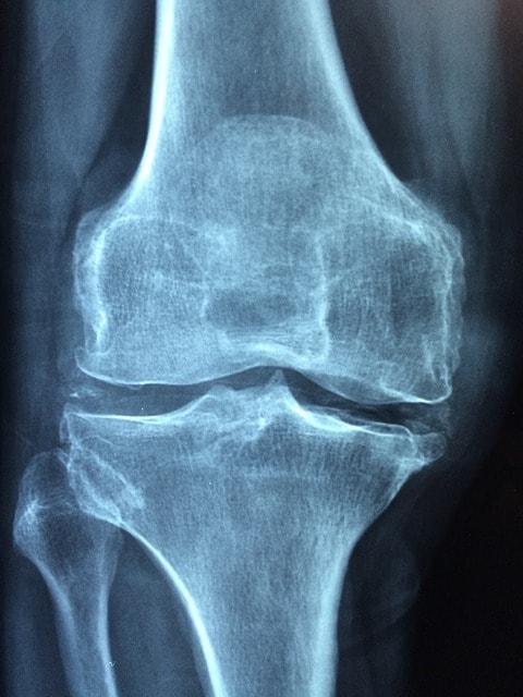 Knee 1406964 640 Min