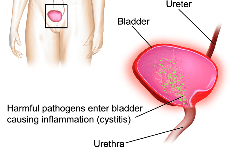 Urinary Tract Infection Min