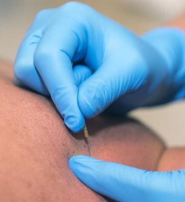 dry needling benefits and research|||||||
