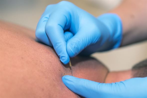 dry needling benefits and research|||||||