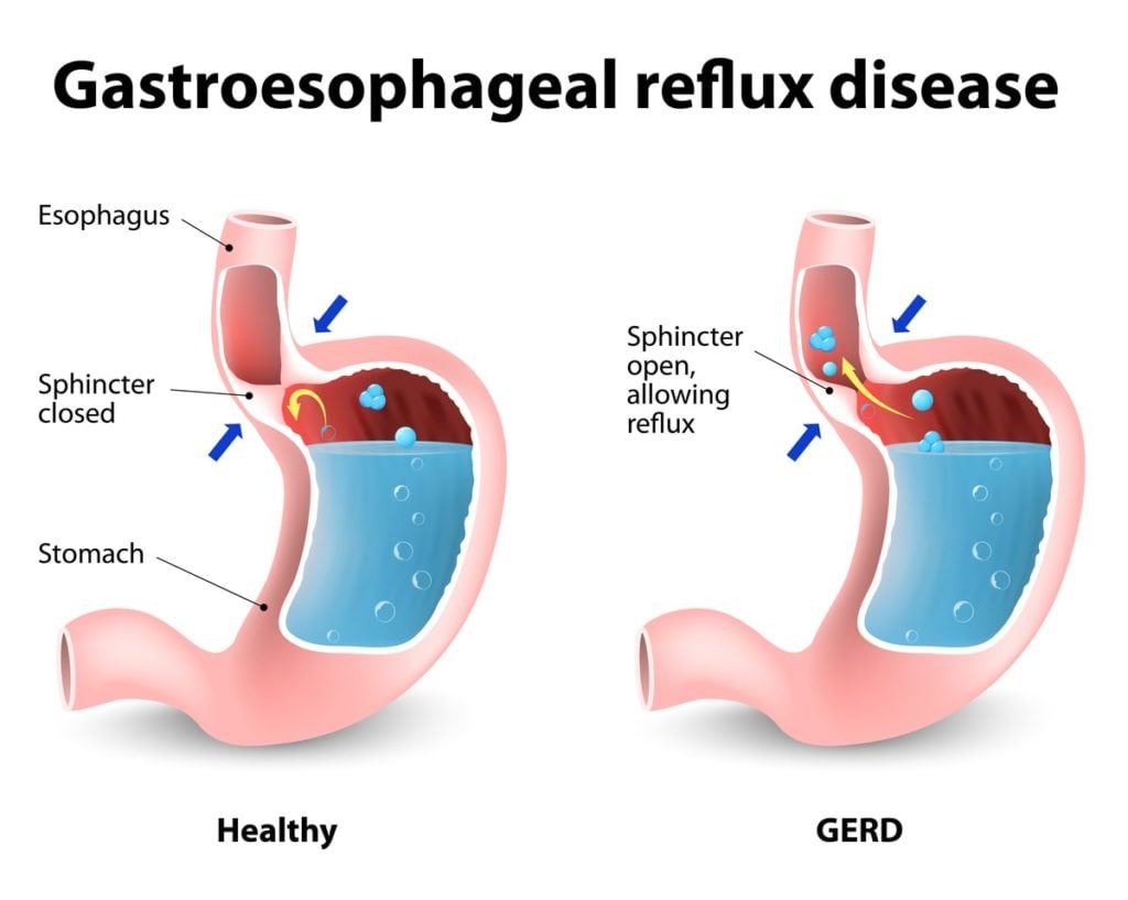 Acid Reflux Explantion