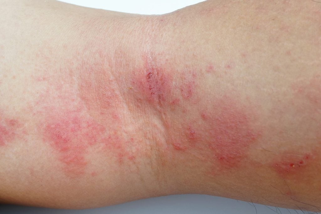 Juice Cleanses And Eczema Will Juicing Help Eczema Sufferers