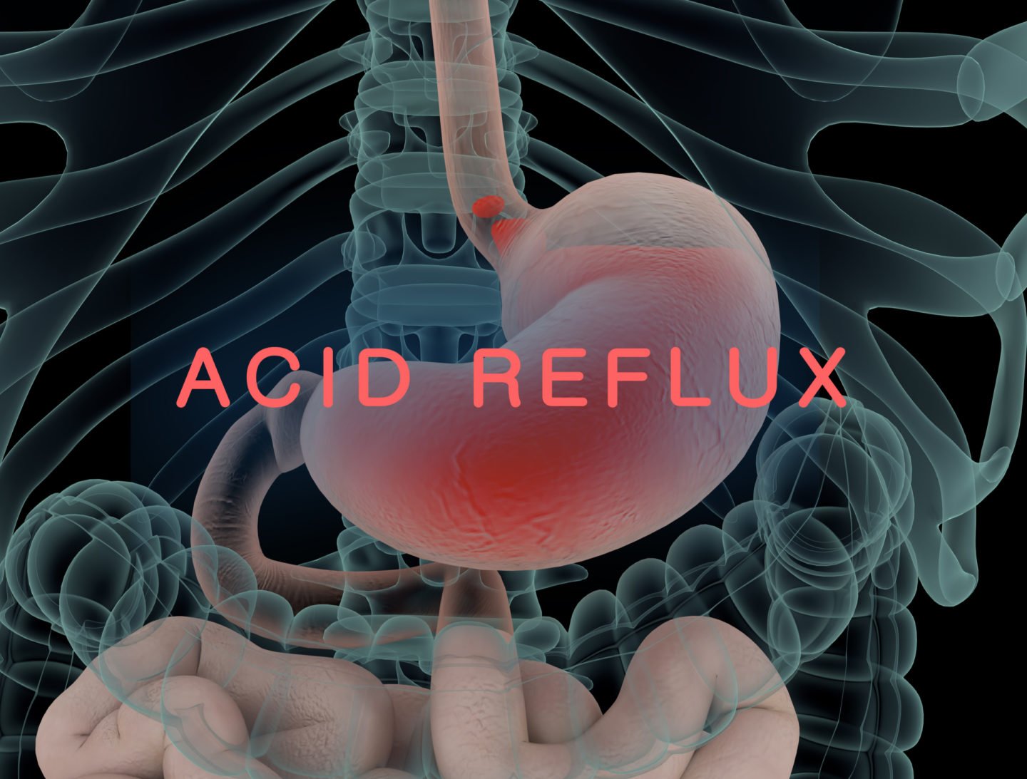 acid reflux illustration