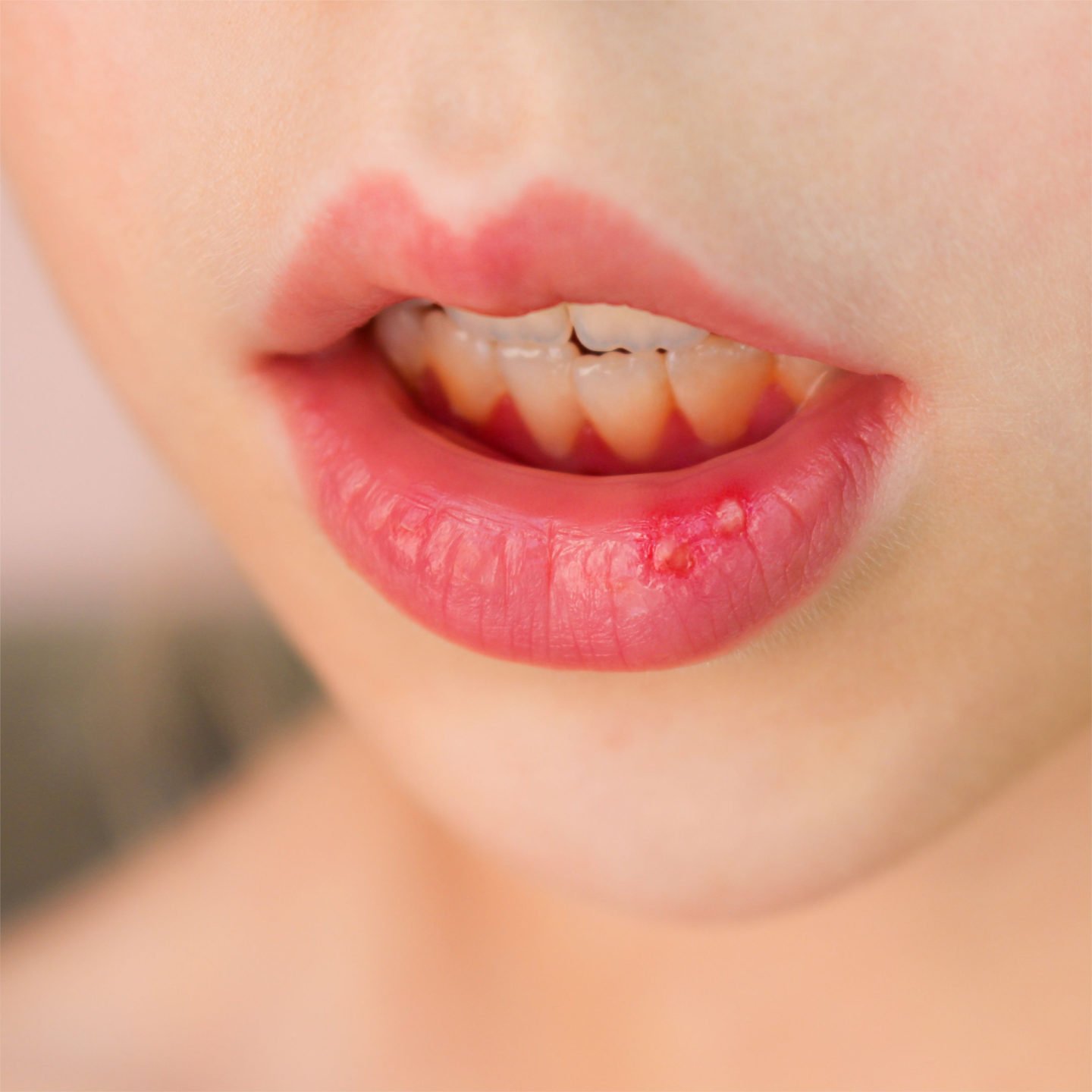 Canker Sore Lower Lip