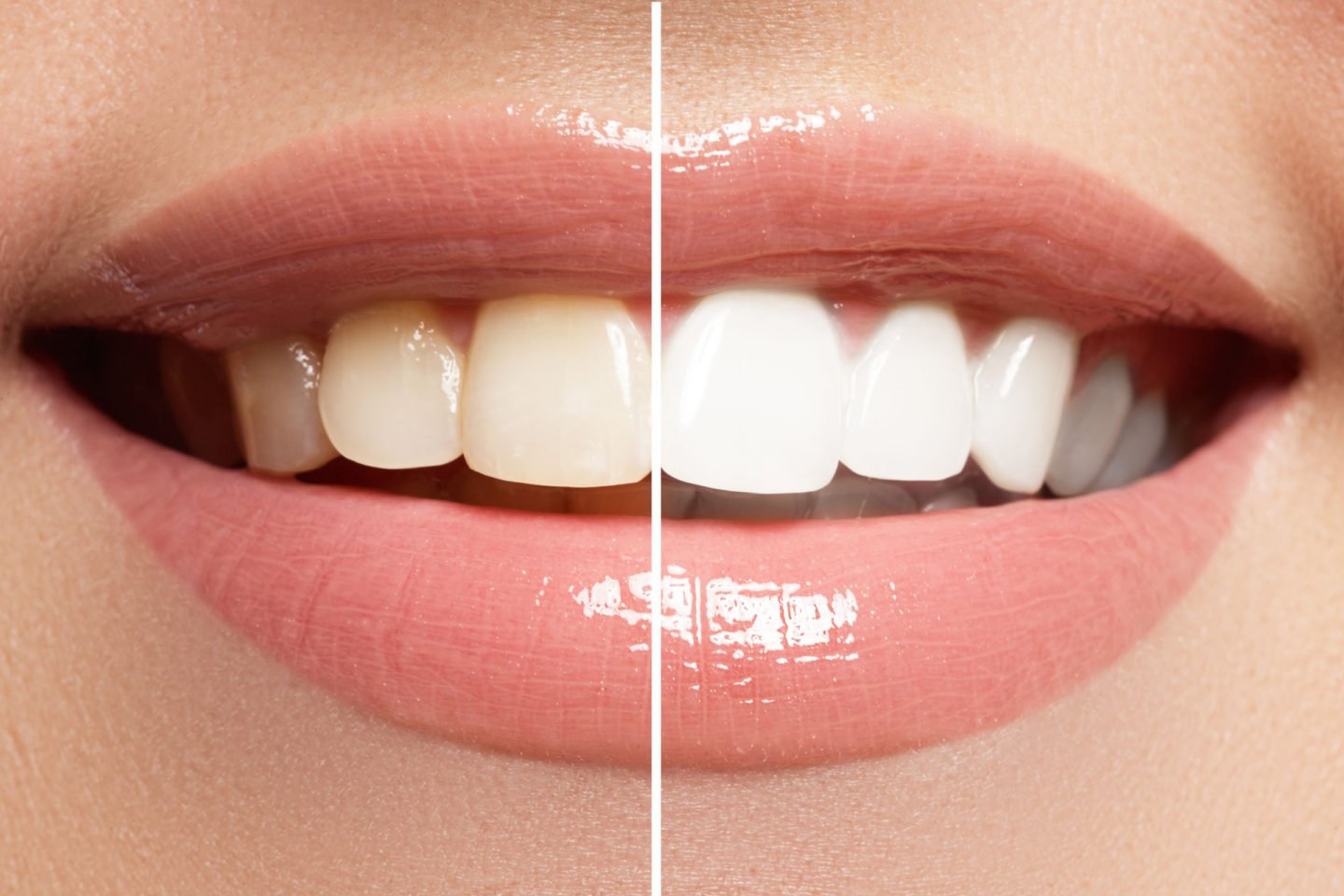 Teeth Whitening Before After