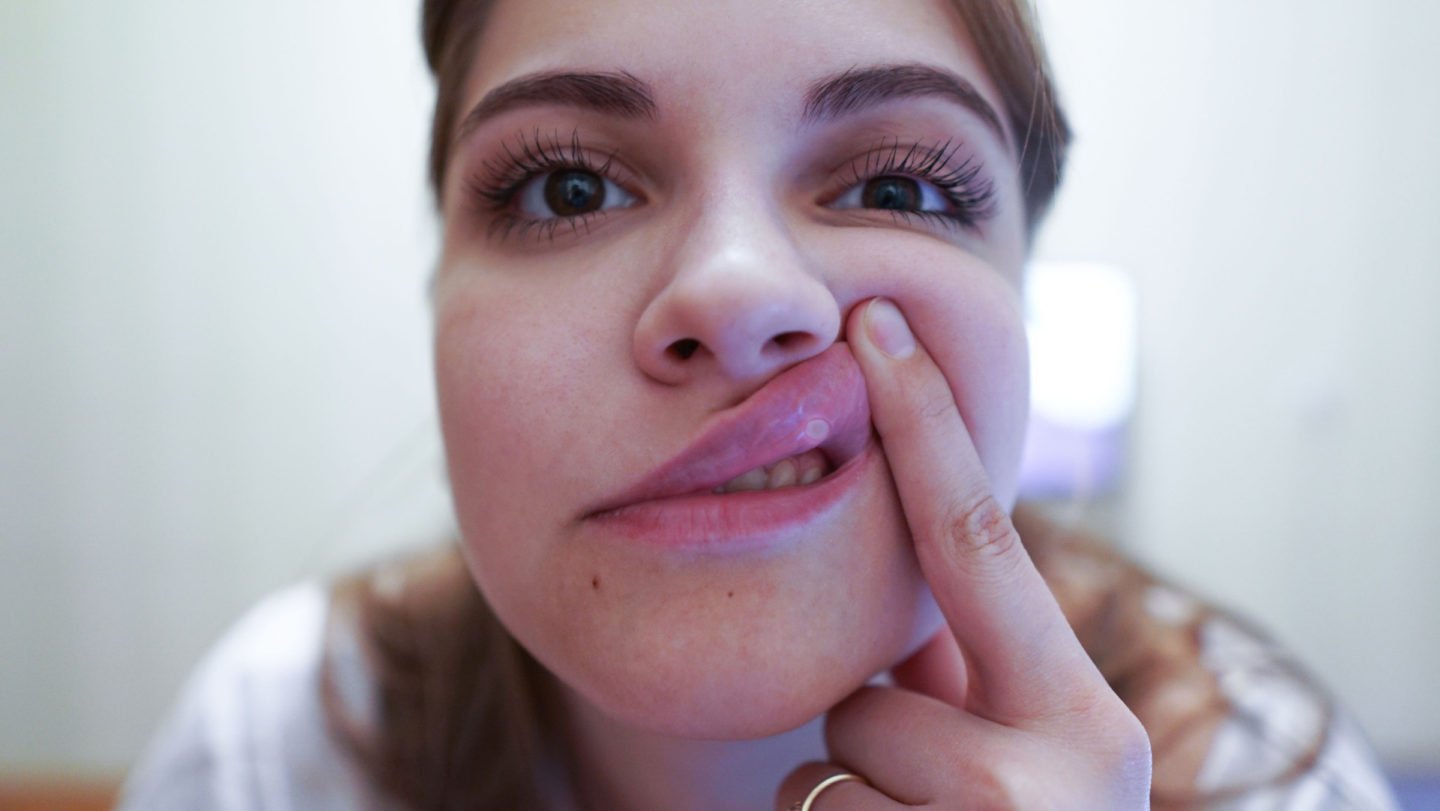 woman with canker sore on upper lip